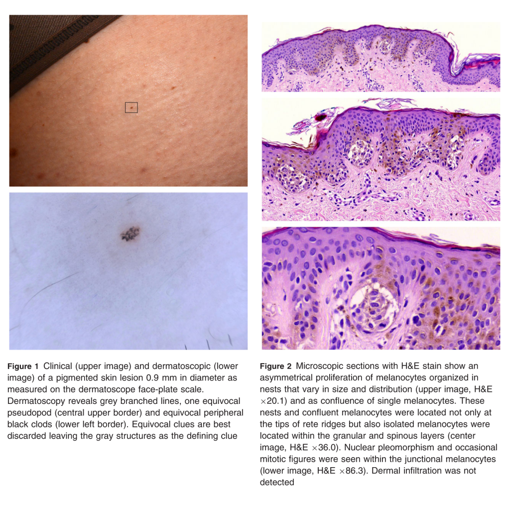 Fotofinder finds the smallest published melanoma on the planet