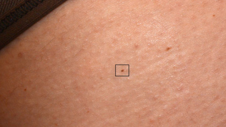 Fotofinder finds the smallest published melanoma on the planet