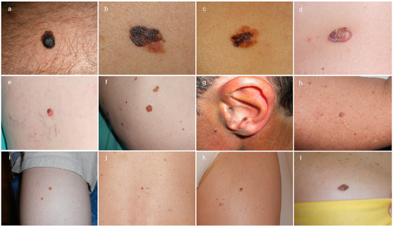 The role of dermoscopy and digital dermoscopy follow-up in the clinical diagnosis of melanoma: clinical and dermoscopic features of 99 consecutive primary melanomas
