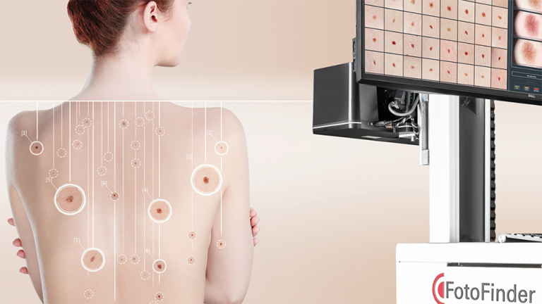Total body dermoscopy