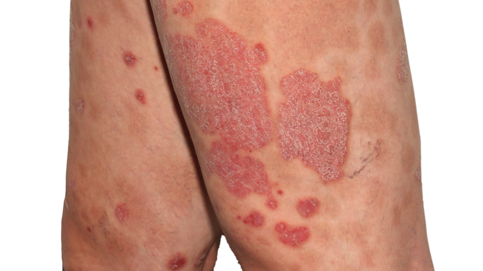 Psoriasis PASI Assessment
