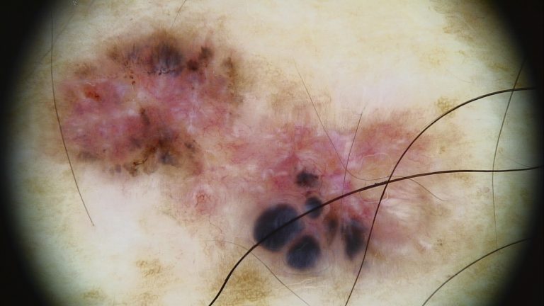 Pigmented basal cell carcinoma